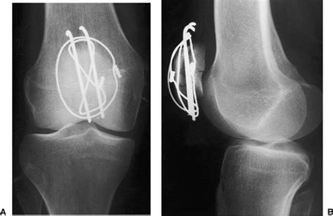 Patellectomy | Musculoskeletal Key