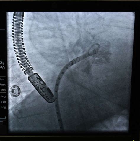 Innovative Watchman procedure offered at Conroe Regional Medical Center