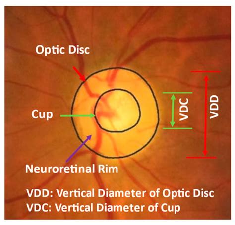 Diagnostics | Free Full-Text | Identifying Those at Risk of Glaucoma: A ...