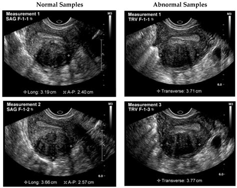 Uterine Fibroids