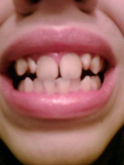 What to Do with Gapped and Two Big Front Teeth? Dentist Answers, Tips