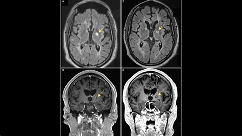 Medial Longitudinal Fasciculus Lesions - The Neurology Hub