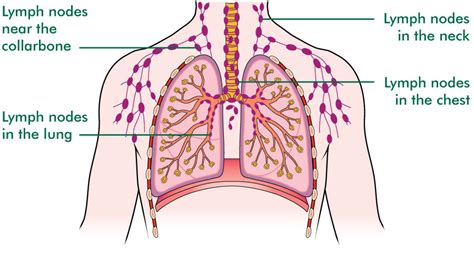 Hilar Lymph Nodes Lung Cancer