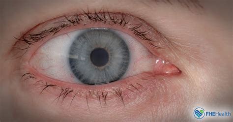 Understanding Bloodshot Eyes and Dilated Pupils in Drug Abuse | FHE Health