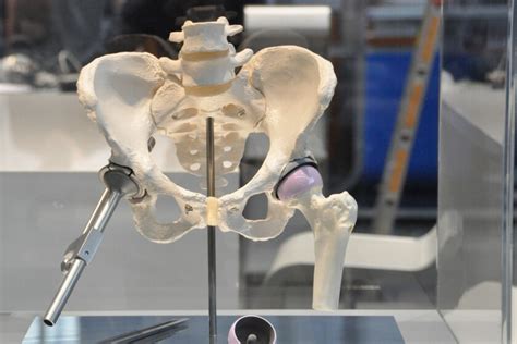 German scientists creating a high-tech artificial hip