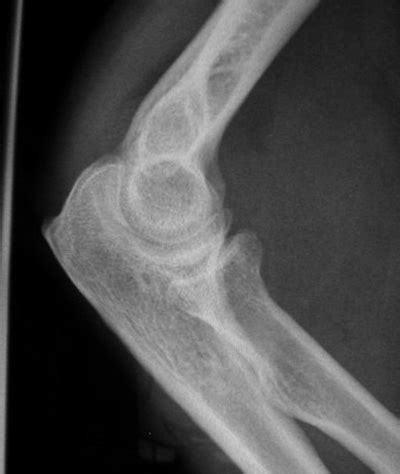 Elbow X Ray Fracture