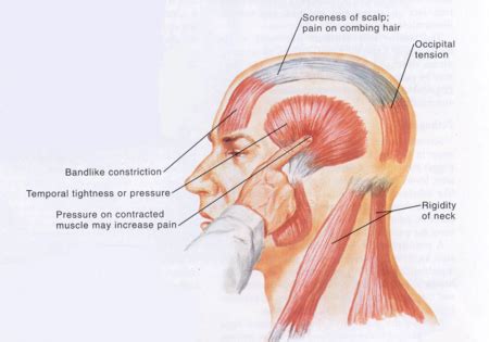 Tension-type headache - Physiopedia