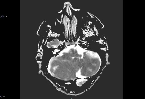 MRI Dysplastic cerebellar gangliocytoma (Lhermitte-Duclos disease)