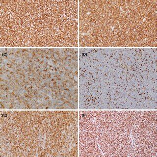 Cervical lymph node biopsy, immunohistochemical studies. (A) CD3 (20× ...