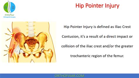 Hip Pointer Injury • Easy Explained - OrthoFixar 2022 in 2022 | Injury ...