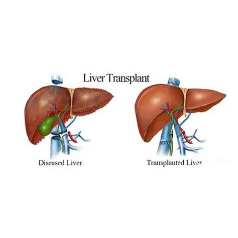 Factors that Influence Liver Transplant Survival