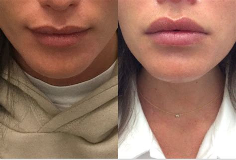 A lip flip can give you fuller, poutier lips in 20 minutes: Here's how the Botox procedure works