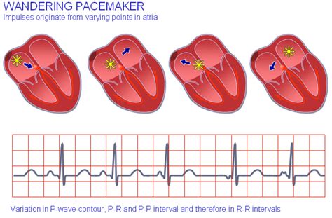 Wandering Pacemaker | Medical school essentials, Medical knowledge, Diagnosis