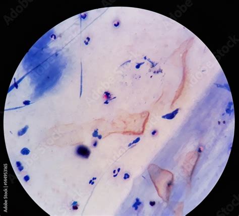 Smear of Acid-Fast bacilli (AFB) stained from sputum specimen with positive Mycobacterium ...