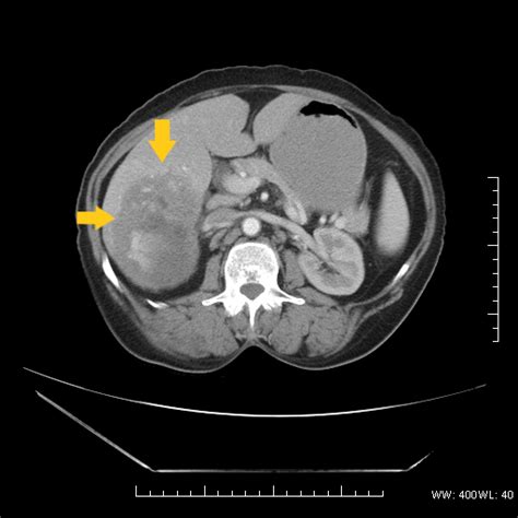 Hepatocellular adenoma CT scan - wikidoc