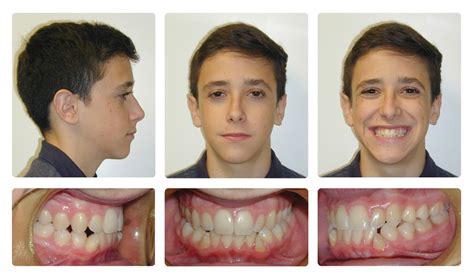 Orthodontic Before and After Photos | Brodsky Orthodontics