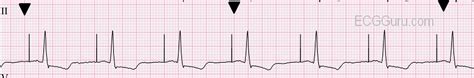 ECG Basics: Atrial Pacing | ECG Guru - Instructor Resources