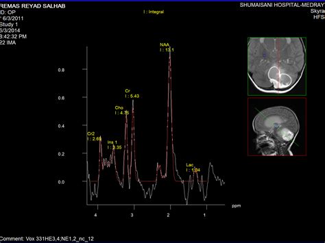 MRI SPECTROSCOPY