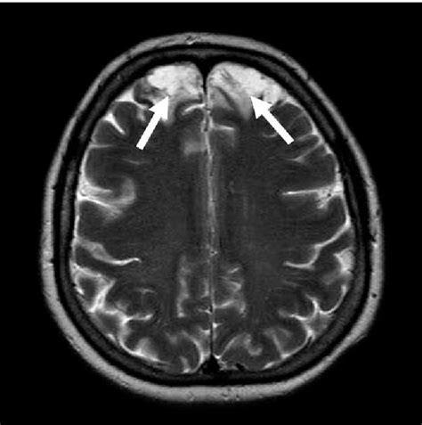 T2-weighted MRI of central nervous system showing bilateral contusion ...