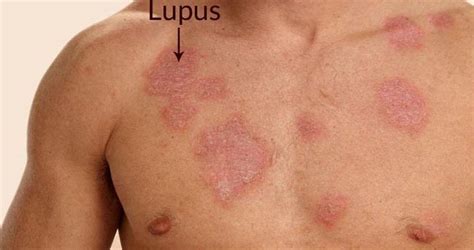 Pin on LUPUS