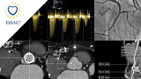 New-onset breathlessness following bioprosthetic surgical aortic valve ...