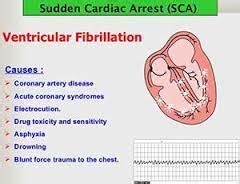 Ghim trên Ventricular Fibrillation