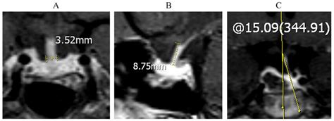 The width, length and deviation angle of pituitary stalk were measured ...