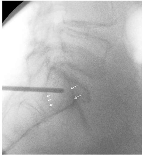 Exact lateral view of the lumbosacral junction. The tip of the drill... | Download Scientific ...