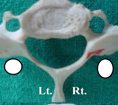 Anatomical Variations of Foramen Transversarium of 7th Cervical Vertebrae and Its Clinical ...