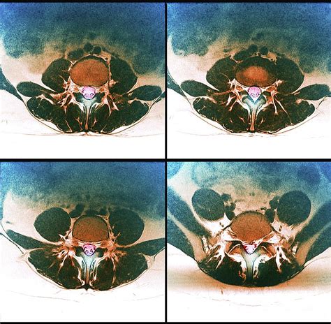 Herniated Disk In Sciatica Photograph by Zephyr/science Photo Library - Pixels