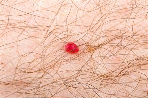 Seeing Spots? Here’s the Deal With Those Bright Red Angiomas - Dr. Pimple Popper