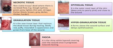 Types of Chronic wounds - Indie Media Mag