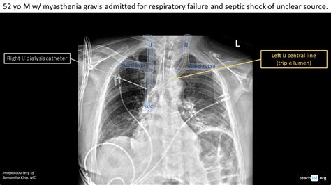 Central Line Placement - CXR - teachIM