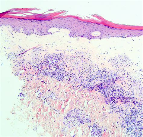 Pathology Outlines - Lichen sclerosus