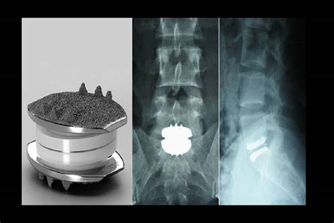 An Overview Of Artificial Cervical Disc Replacement Surgery