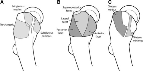 Gluteus Medius and Minimus Tears | Frisco, TX | Orthopedic Surgeon