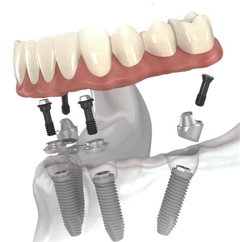 All-on-Four™ Dental Implants Lake Jackson, Brazosport, Angleton – Bell Dental