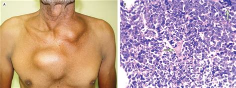 Multiple chest wall swellings in adult Burkitt's lymphoma - The Lancet