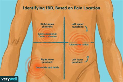 What Inflammatory Bowel Disease Pain Feels Like