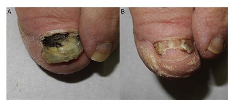 Figure 1 from Proximal Subungual Onychomycosis Due to Aspergillus niger: A Simulator of ...