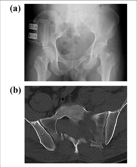 (a) Radiograph at the time of the injury shows left sacral fracture... | Download Scientific Diagram