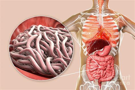 Roundworms In Humans