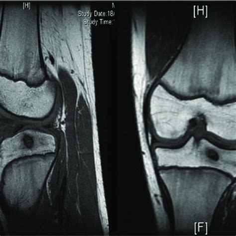 Standard diagnosis of tibial eminence fracture could be established... | Download Scientific Diagram