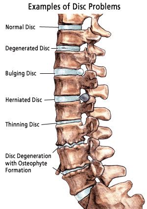 Neuro Operations: Lumbar Spine