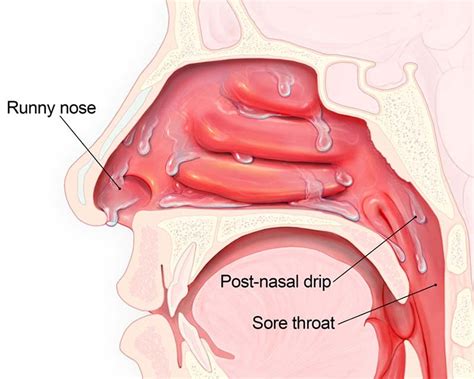 ENT problems in Children | ENT Specialist Singapore