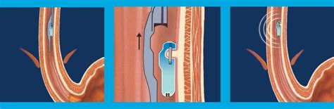 Bravo pH - Advanced Gastroenterology Associates