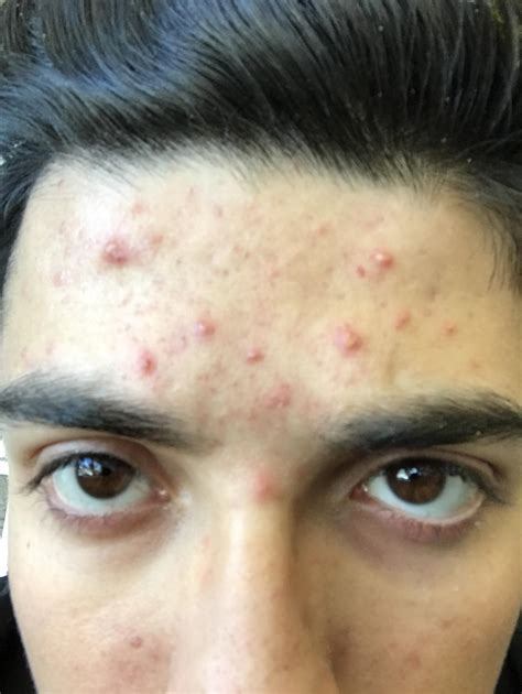 Acne on forehead getting worse - General acne discussion - by Ralphhossine - Acne.org Community