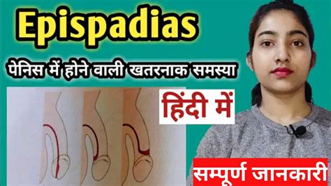 Epispadias in hindi|Epispadias| Alka medical classes - YouTube