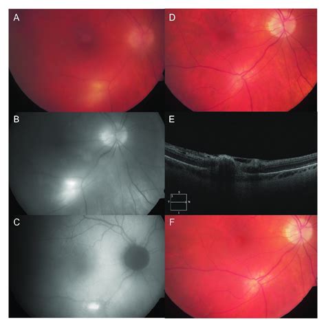 Case 1 with active toxoplasmosis retinochoroiditis following a ...