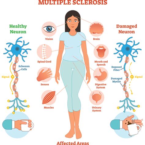 Multiple Sclerosis / Multiple Sclerosis Symptoms And Causes Mayo Clinic : Treatment typically ...